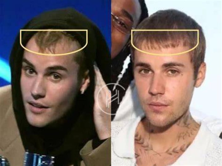 Justin Bieber Hair Loss Everything You Need To Know Wimpole Clinic