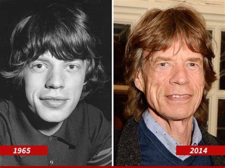 Mick Jagger Lips Surgery