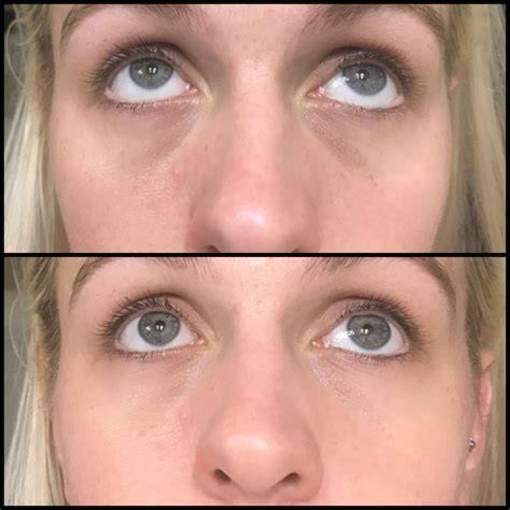 No more tired eyes Bye Dark Circles and eye bags Hydrate eyes, Eye