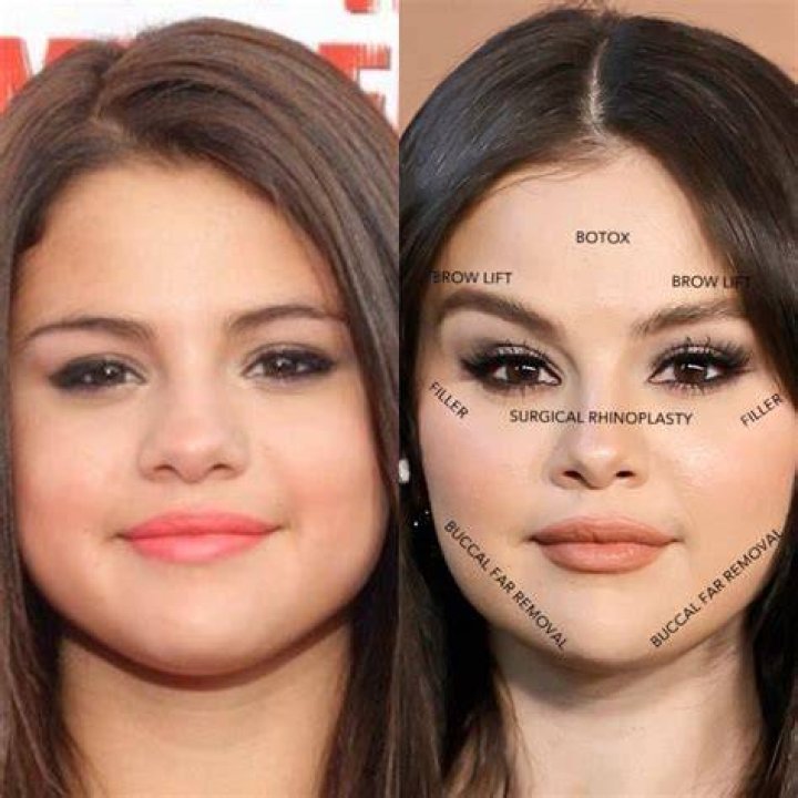 Selena Gomez Plastic Surgery or Lupus? Why Fans are Wrong